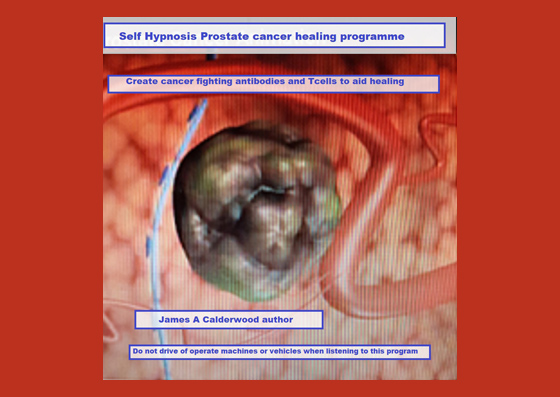 Self hypnosis prostate cancer Healing Programme